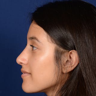 Female Rhinoplasty Before & After Gallery - Patient 415050 - Image 4