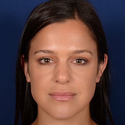 Female Rhinoplasty Before & After Gallery - Patient 107297 - Image 1