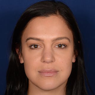 Female Rhinoplasty Before & After Gallery - Patient 107297 - Image 2