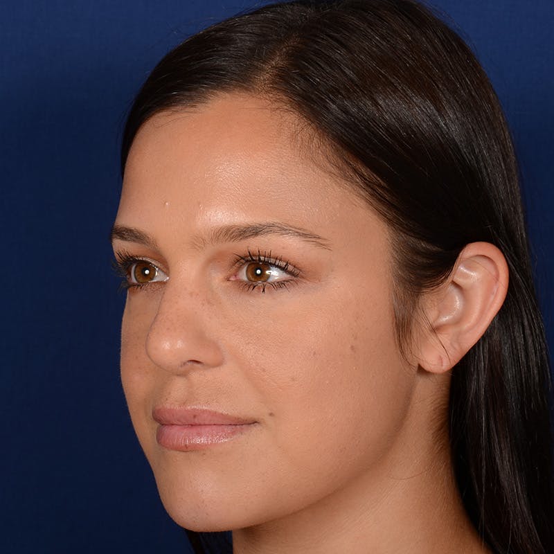Female Rhinoplasty Before & After Gallery - Patient 107297 - Image 4