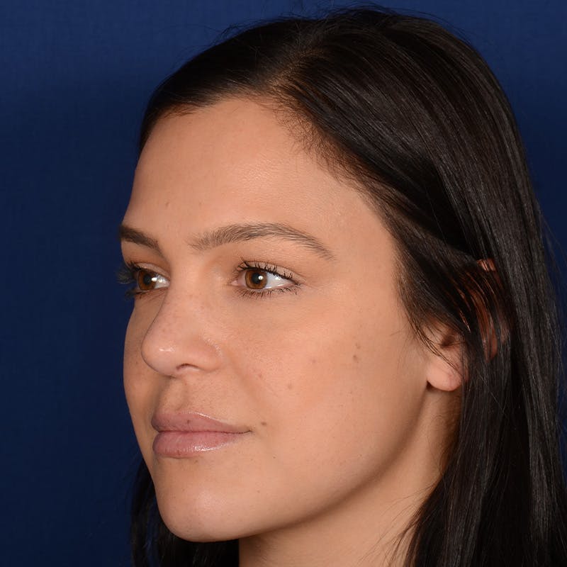 Female Rhinoplasty Before & After Gallery - Patient 107297 - Image 3