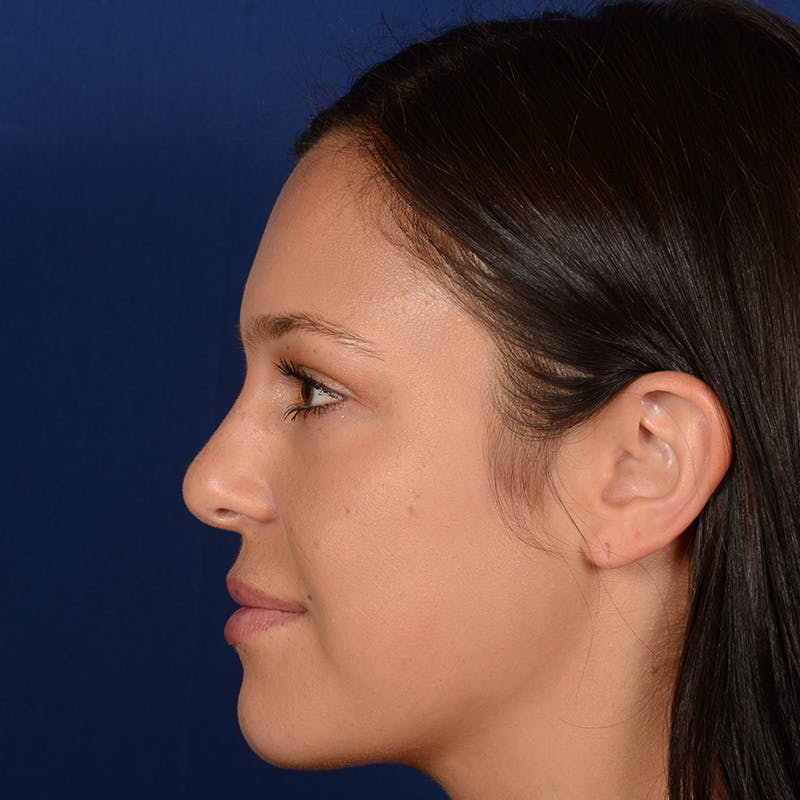 Female Rhinoplasty Before & After Gallery - Patient 107297 - Image 5