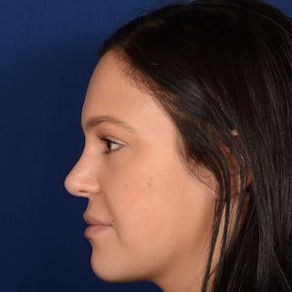 Female Rhinoplasty Before & After Gallery - Patient 107297 - Image 6