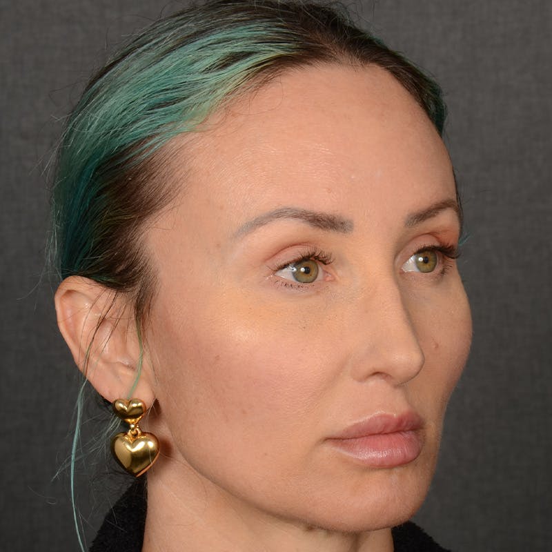 Female Rhinoplasty Before & After Gallery - Patient 891680 - Image 3