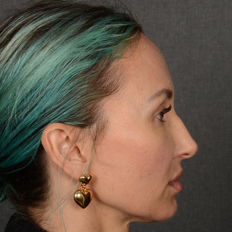 Female Rhinoplasty Before & After Gallery - Patient 891680 - Image 5
