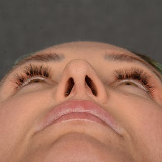 Female Rhinoplasty Before & After Gallery - Patient 891680 - Image 8