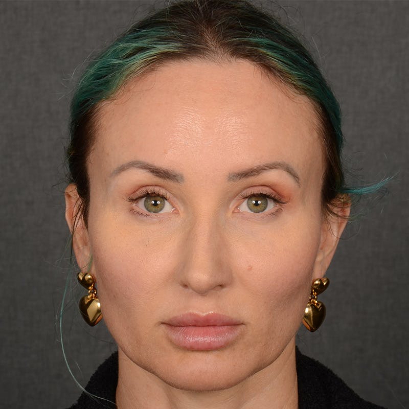 Female Rhinoplasty Before & After Gallery - Patient 891680 - Image 1