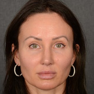 Female Rhinoplasty Before & After Gallery - Patient 891680 - Image 2