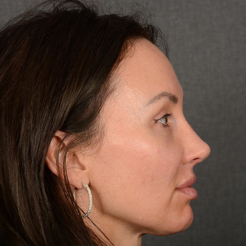 Female Rhinoplasty Before & After Gallery - Patient 891680 - Image 6