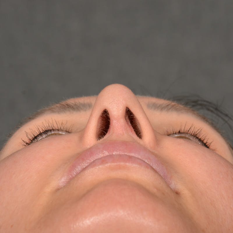 Female Rhinoplasty Before & After Gallery - Patient 891680 - Image 7