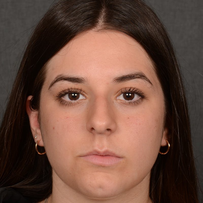 Female Rhinoplasty Before & After Gallery - Patient 203247 - Image 1
