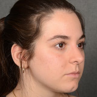 Female Rhinoplasty Before & After Gallery - Patient 203247 - Image 4