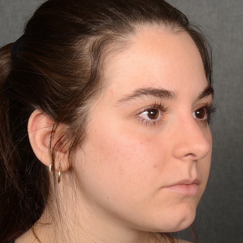 Female Rhinoplasty Before & After Gallery - Patient 203247 - Image 3
