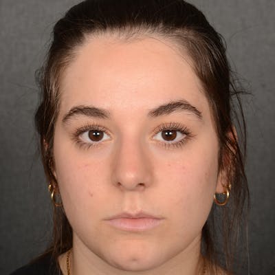 Female Rhinoplasty Before & After Gallery - Patient 203247 - Image 2