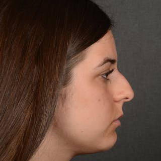 Female Rhinoplasty Before & After Gallery - Patient 203247 - Image 6