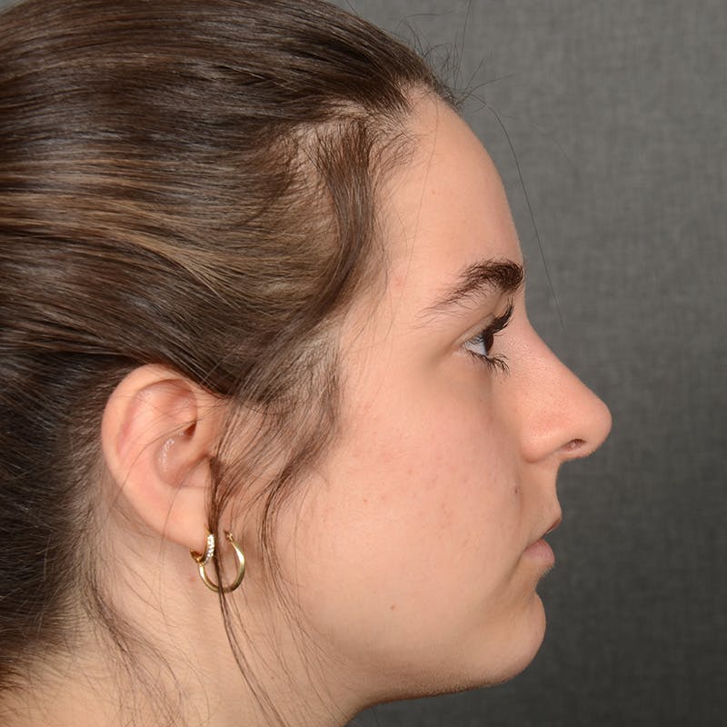 Female Rhinoplasty Before & After Gallery - Patient 203247 - Image 5
