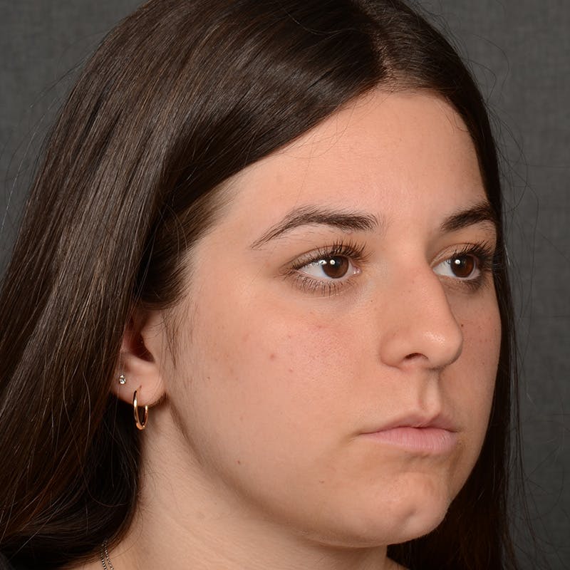 Female Rhinoplasty Before & After Gallery - Patient 203247 - Image 4