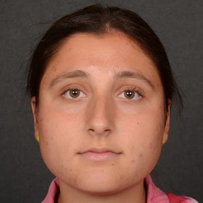 Female Rhinoplasty Before & After Gallery - Patient 553279 - Image 1