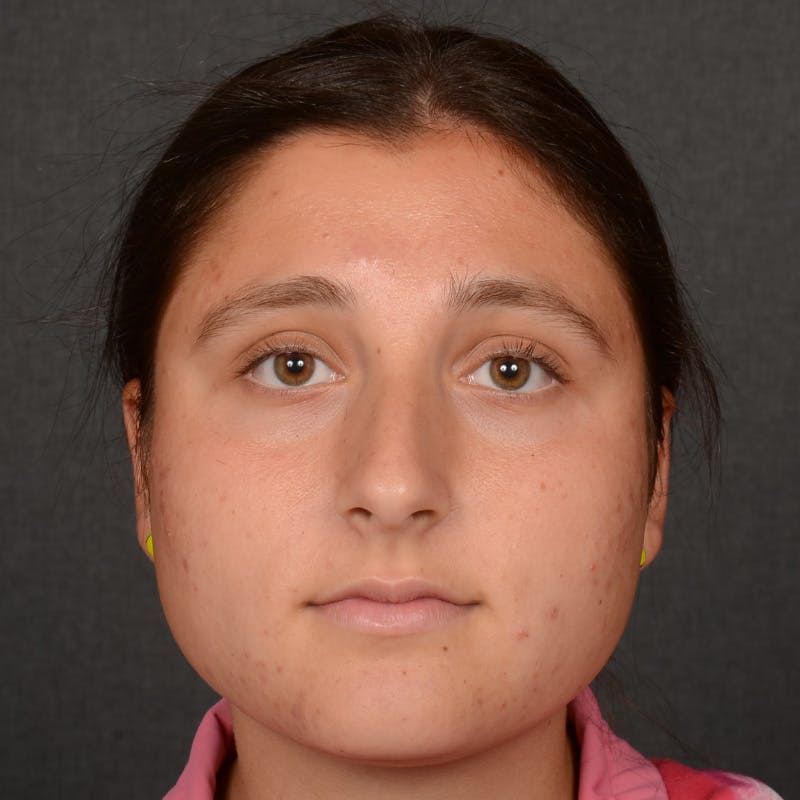 Female Rhinoplasty Before & After Gallery - Patient 553279 - Image 1