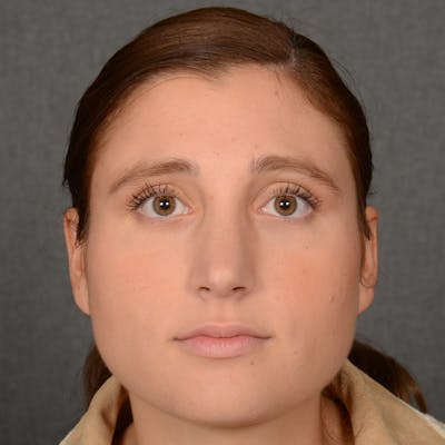 Female Rhinoplasty Before & After Gallery - Patient 553279 - Image 2