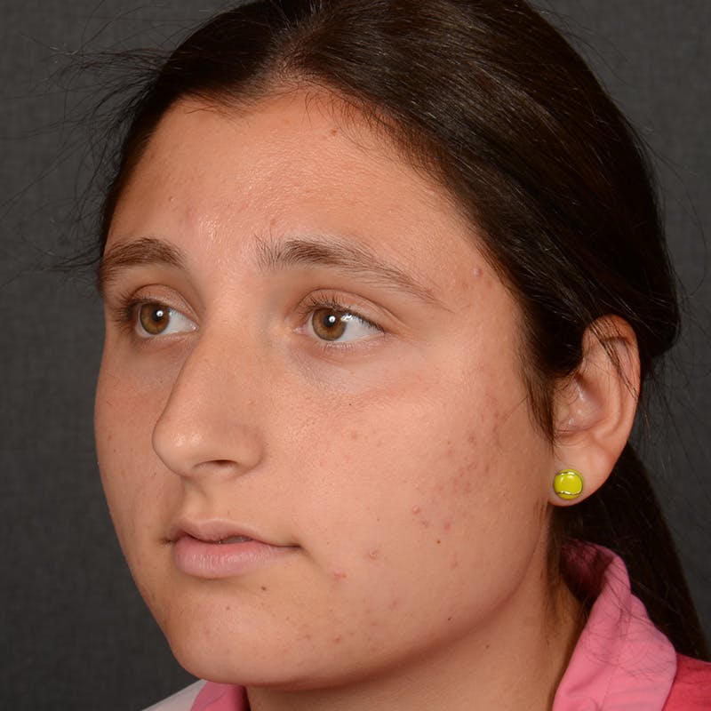 Female Rhinoplasty Before & After Gallery - Patient 553279 - Image 3