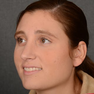 Female Rhinoplasty Before & After Gallery - Patient 553279 - Image 4