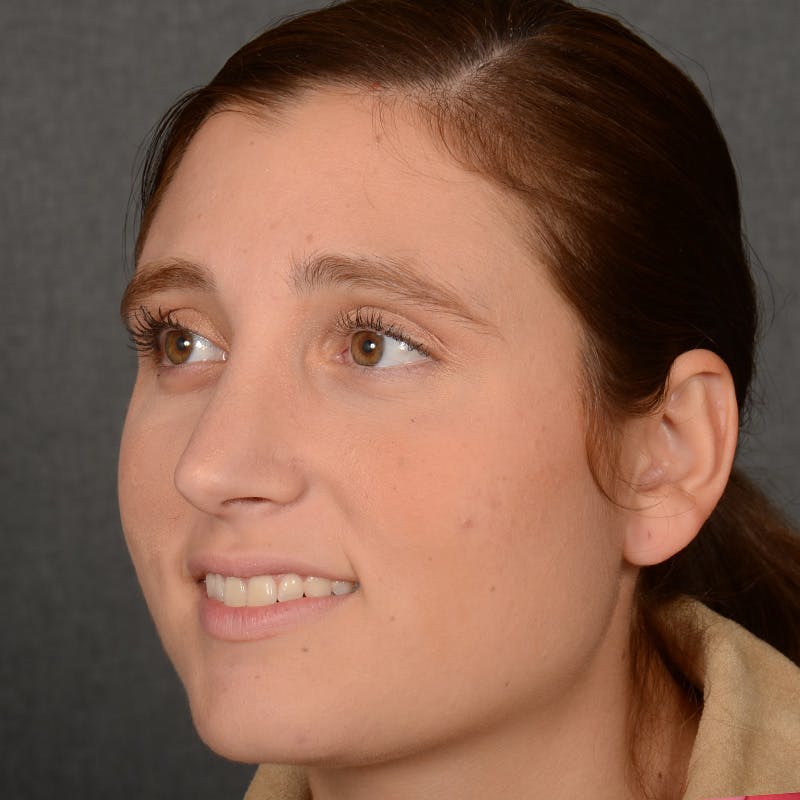Female Rhinoplasty Before & After Gallery - Patient 553279 - Image 4
