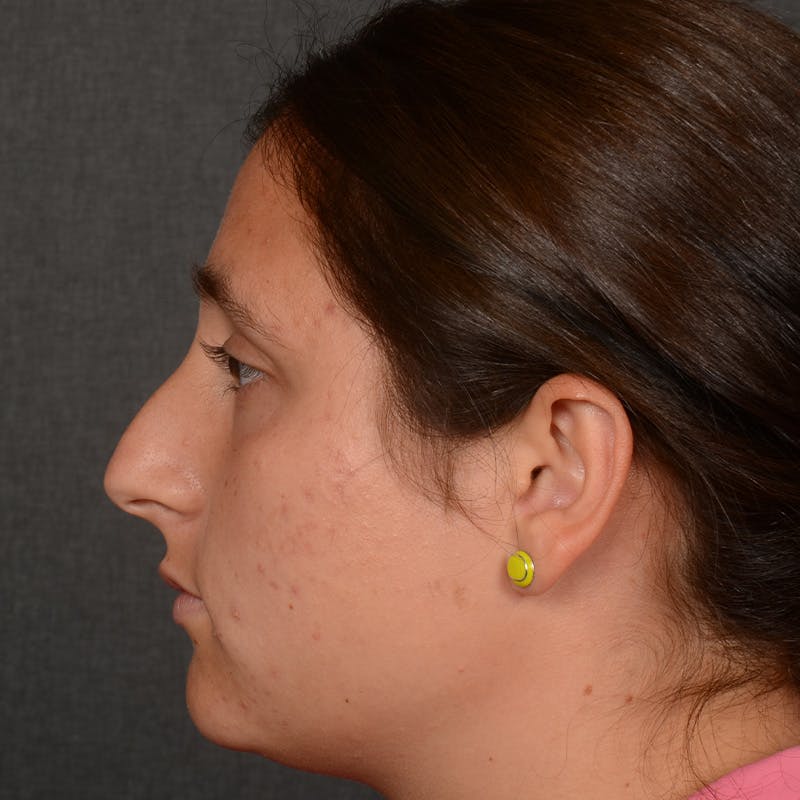 Female Rhinoplasty Before & After Gallery - Patient 553279 - Image 5