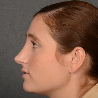 Female Rhinoplasty Before & After Gallery - Patient 553279 - Image 6