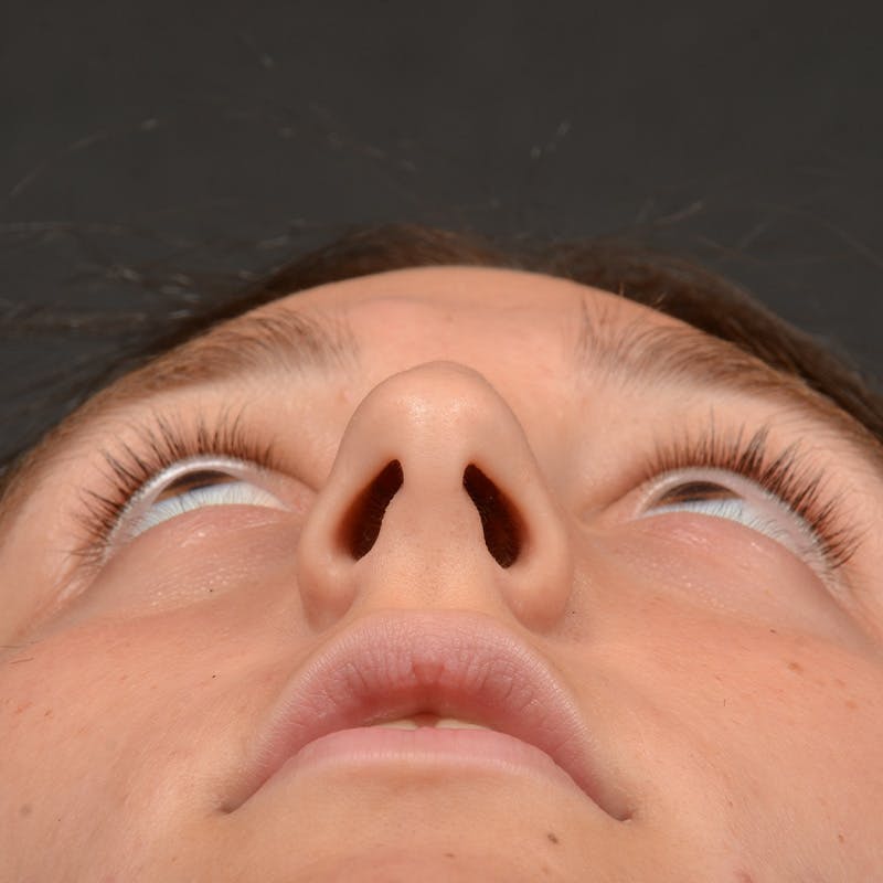 Female Rhinoplasty Before & After Gallery - Patient 553279 - Image 7