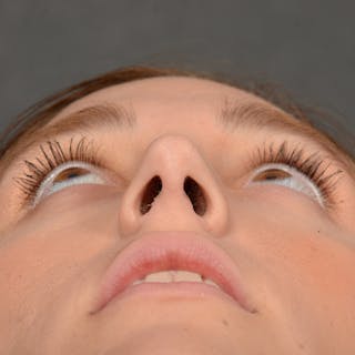 Female Rhinoplasty Before & After Gallery - Patient 553279 - Image 8