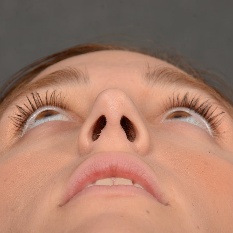 Female Rhinoplasty Before & After Gallery - Patient 553279 - Image 8