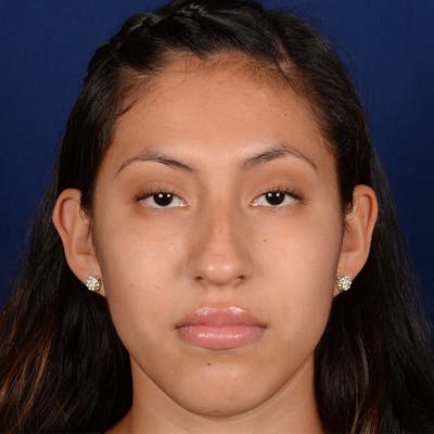 Female Rhinoplasty Before & After Gallery - Patient 372145 - Image 1