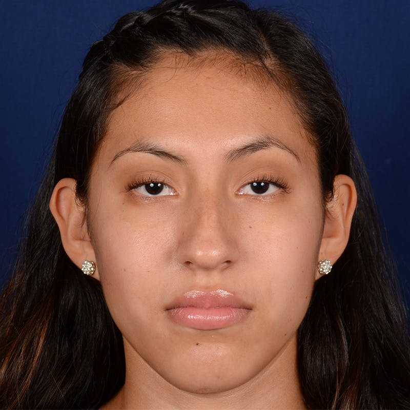 Female Rhinoplasty Before & After Gallery - Patient 372145 - Image 1