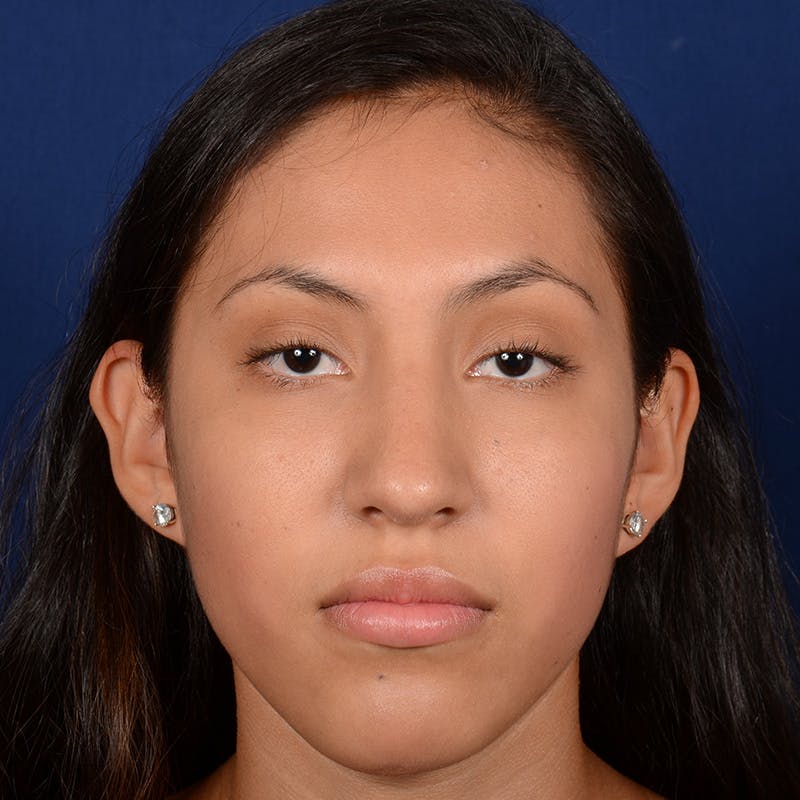 Female Rhinoplasty Before & After Gallery - Patient 372145 - Image 2
