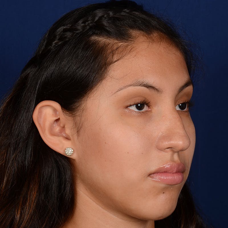 Female Rhinoplasty Before & After Gallery - Patient 372145 - Image 3