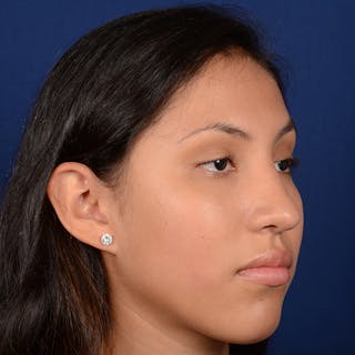 Female Rhinoplasty Before & After Gallery - Patient 372145 - Image 4