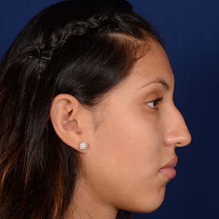 Female Rhinoplasty Before & After Gallery - Patient 372145 - Image 6