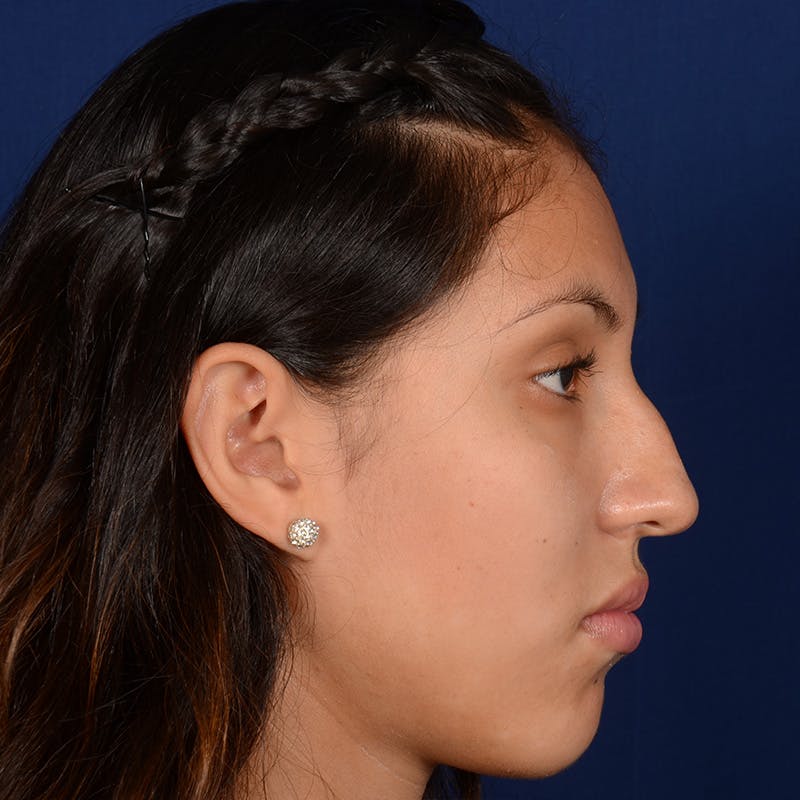 Female Rhinoplasty Before & After Gallery - Patient 372145 - Image 6