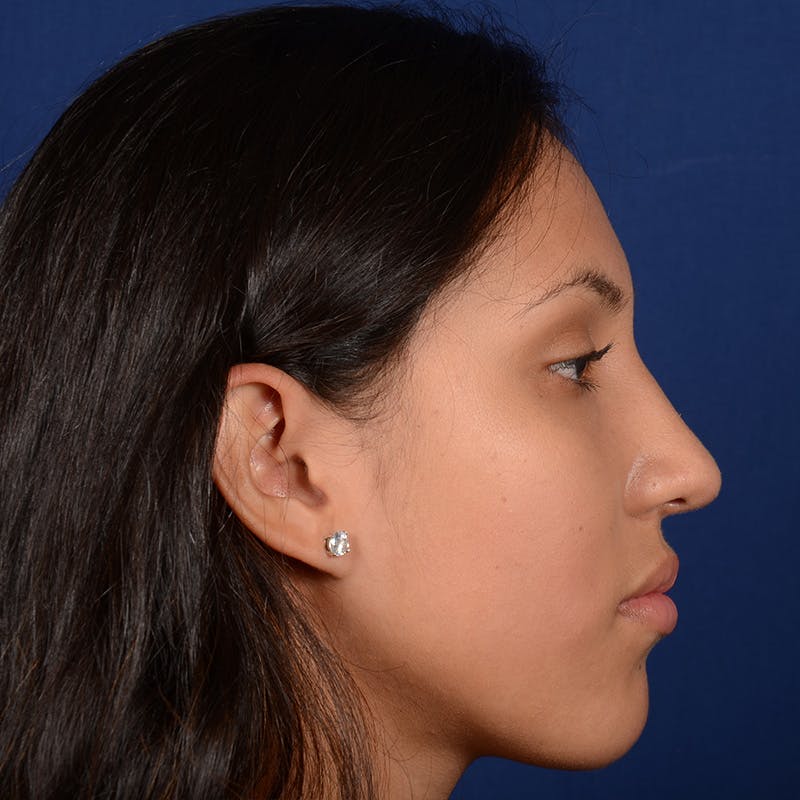 Female Rhinoplasty Before & After Gallery - Patient 372145 - Image 5