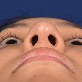 Female Rhinoplasty Before & After Gallery - Patient 372145 - Image 8