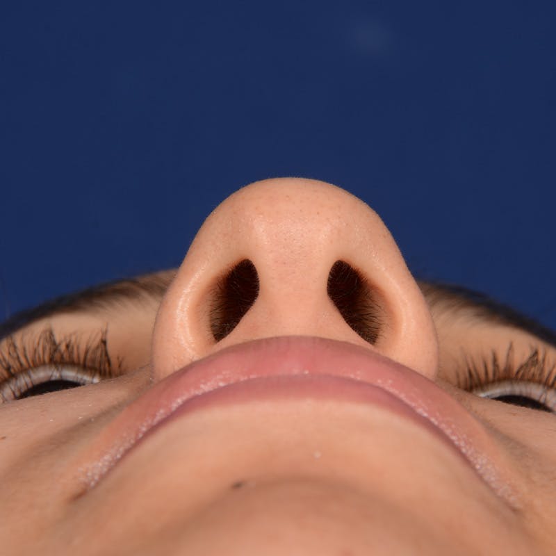 Female Rhinoplasty Before & After Gallery - Patient 372145 - Image 7
