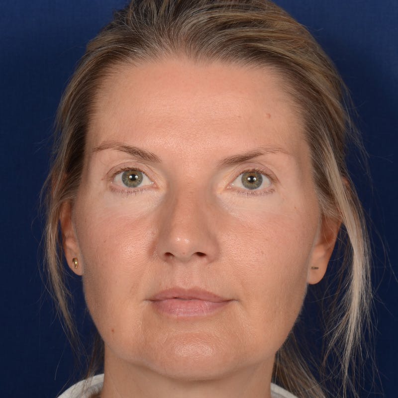 Female Rhinoplasty Before & After Gallery - Patient 329789 - Image 1
