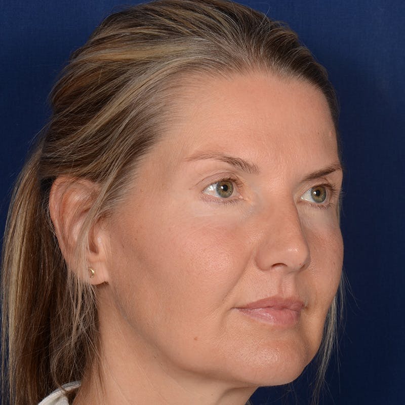 Female Rhinoplasty Before & After Gallery - Patient 329789 - Image 3