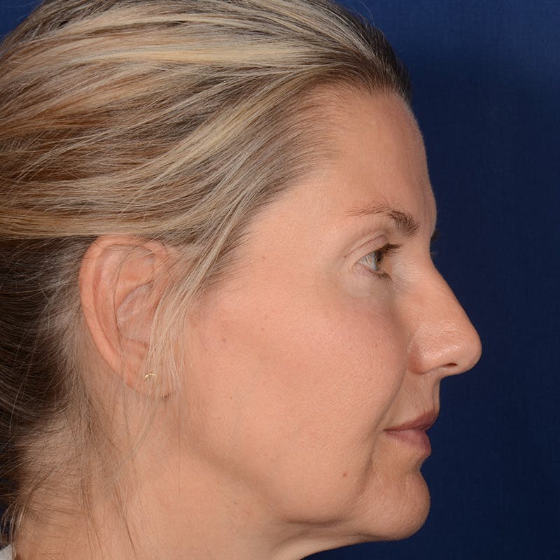 Female Rhinoplasty Before & After Gallery - Patient 329789 - Image 5
