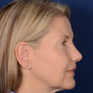 Female Rhinoplasty Before & After Gallery - Patient 329789 - Image 6