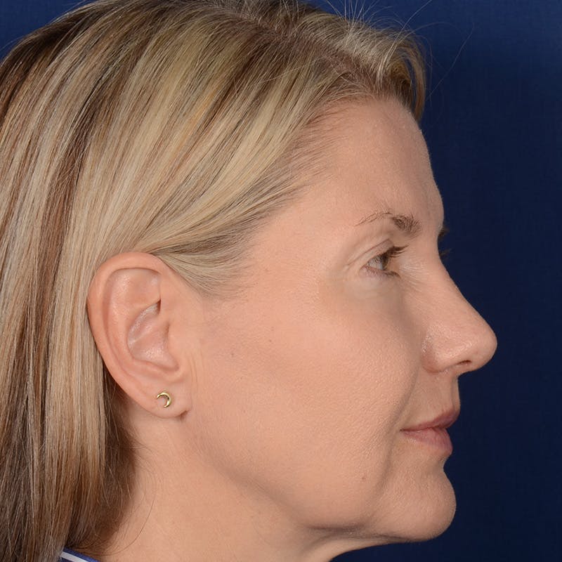 Female Rhinoplasty Before & After Gallery - Patient 329789 - Image 6