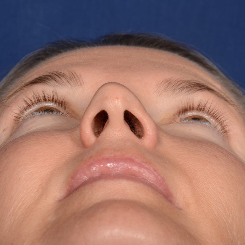 Female Rhinoplasty Before & After Gallery - Patient 329789 - Image 7