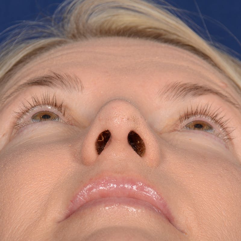 Female Rhinoplasty Before & After Gallery - Patient 329789 - Image 8