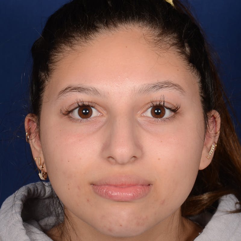 Female Rhinoplasty Before & After Gallery - Patient 518815 - Image 1
